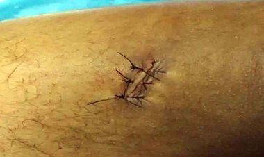 युवती को लेकर जमकर विवाद, युवक को मारा चाकू, पैर में लगे टाके, अस्पताल में भर्ती, रायपुर पुलिस ने आरोपी राहुल को किया गिरफ्तार