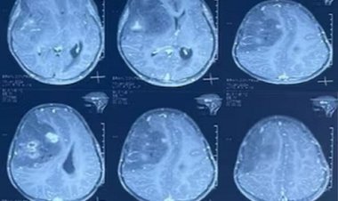 7 साल की बच्ची के दिमाग में था बेर से बड़ा ट्यूमर,डॉक्टरों ने ऑपरेशन कर निकाला