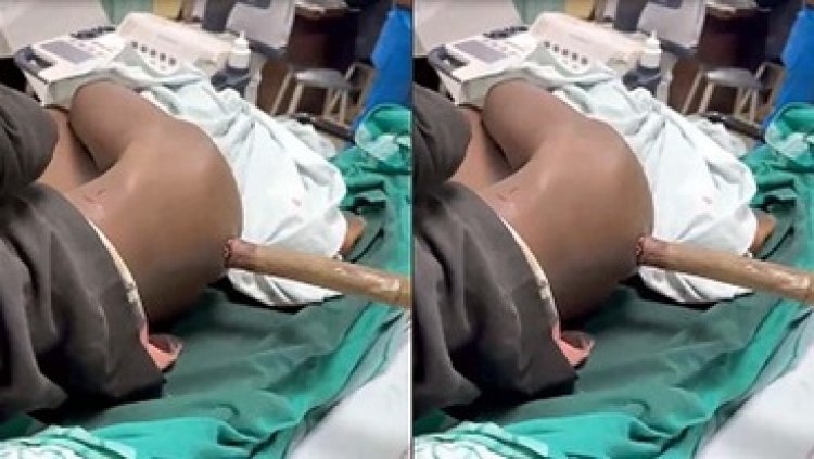 मजदूर के पेट में घुसा 15 फीट लंबा बांस, OT में डॉक्टरों ने बुलाया कारपेंटर,  मिस्त्री की मदद से डॉक्टरों ने ऑपरेशन कर बचाई जान