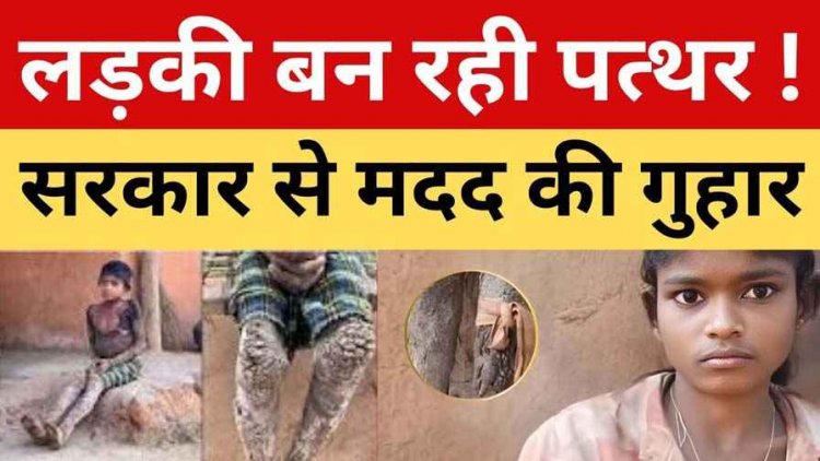 14 वर्षीय आदिवासी लड़की का शरीर धीरे-धीरे बन रहा पत्थर, खौफनाक बीमारी ने बदली मासूम की जिंदगी, त्वचा पर उग आई कांटेदार परत!