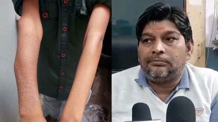 डॉक्टर ने Whatsapp पर एक्स-रे दिखाकर लिया ज्ञान, 9 वर्षीय बच्चे का प्लास्टर करने में कर दी लापरवाही, मासूम सूजन और दर्द से बेहाल