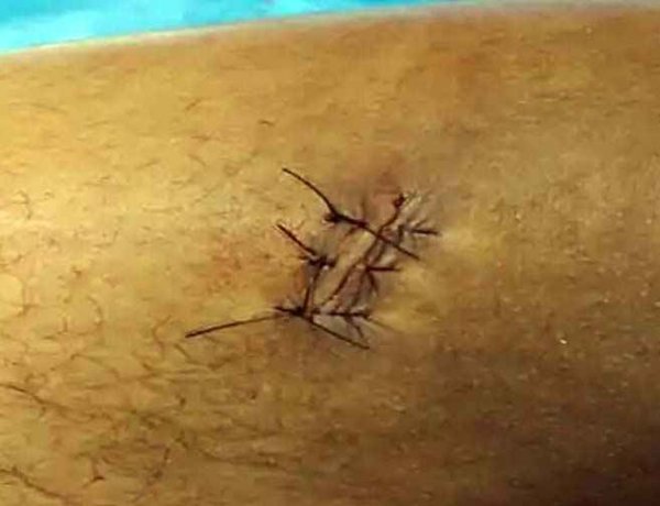 युवती को लेकर जमकर विवाद, युवक को मारा चाकू, पैर में लगे टाके, अस्पताल में भर्ती, रायपुर पुलिस ने आरोपी राहुल को किया गिरफ्तार